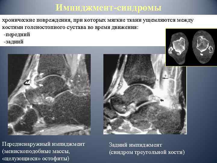 Импиджмент-синдромы хронические повреждения, при которых мягкие ткани ущемляются между костями голеностопного сустава во время