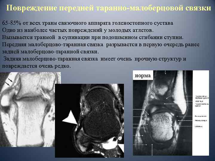 Повреждение передней таранно-малоберцовой связки 65 -85% от всех травм связочного аппарата голеностопного сустава Одно