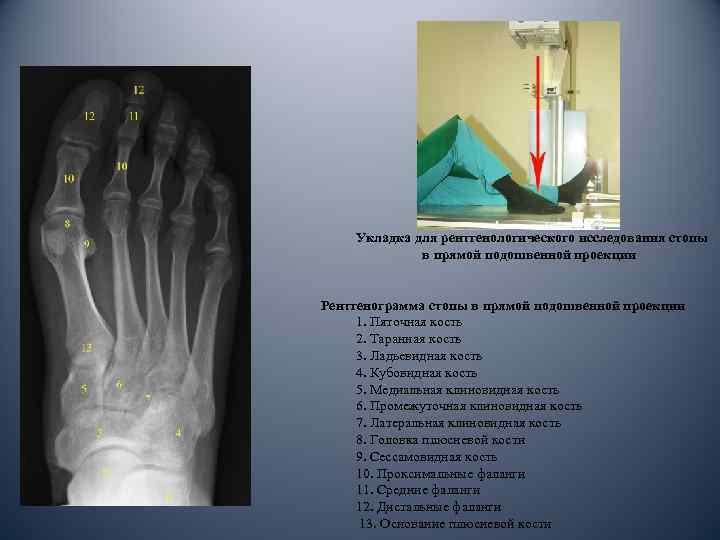Укладка для рентгенологического исследования стопы в прямой подошвенной проекции Рентгенограмма стопы в прямой подошвенной
