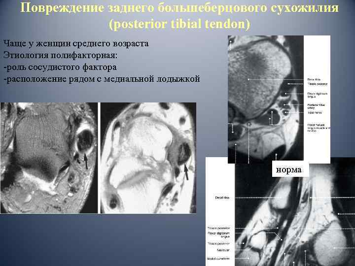 Повреждение заднего большеберцового сухожилия (posterior tibial tendon) Чаще у женщин среднего возраста Этиология полифакторная: