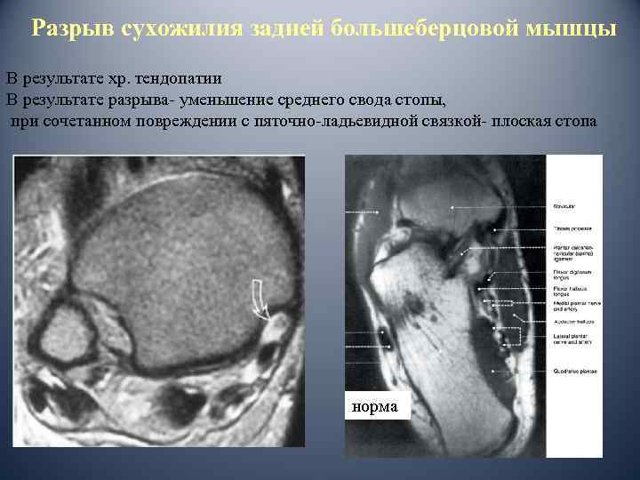 Разрыв сухожилия задней большеберцовой мышцы В результате хр. тендопатии В результате разрыва- уменьшение среднего