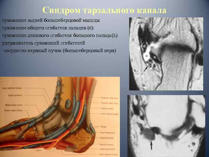 Синдром тарзального канала сухожилие задней большеберцовой мышцы сухожилие общего сгибателя пальцев (d) сухожилие длинного