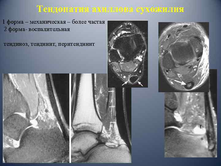 Тендопатия ахиллова сухожилия 1 форма – механическая – более частая 2 форма- воспалительная тендиноз,