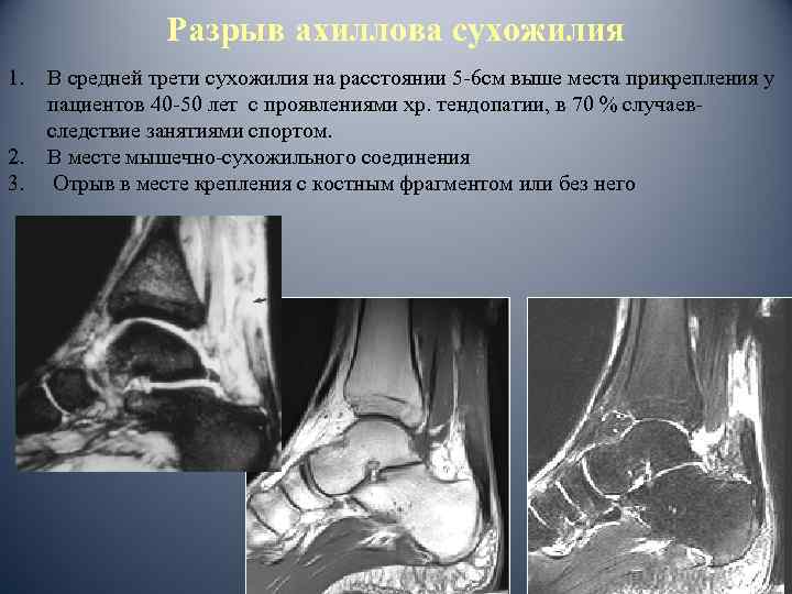 Разрыв ахиллова сухожилия 1. 2. 3. В средней трети сухожилия на расстоянии 5 -6