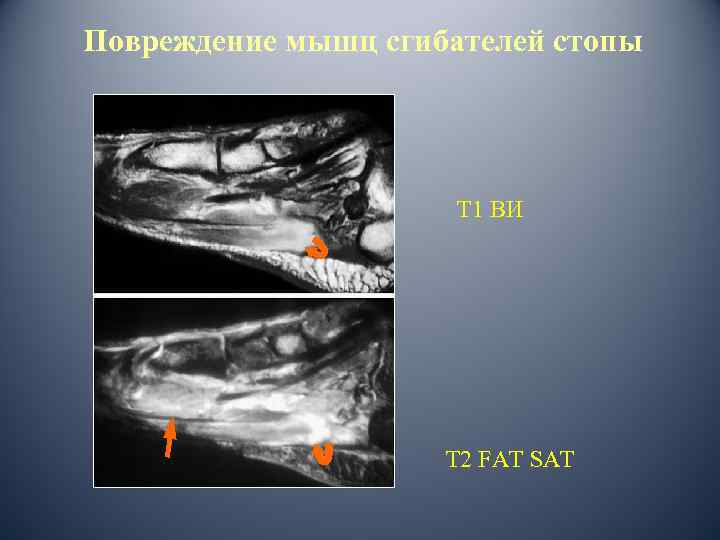 Повреждение мышц сгибателей стопы Т 1 ВИ Т 2 FAT SAT 