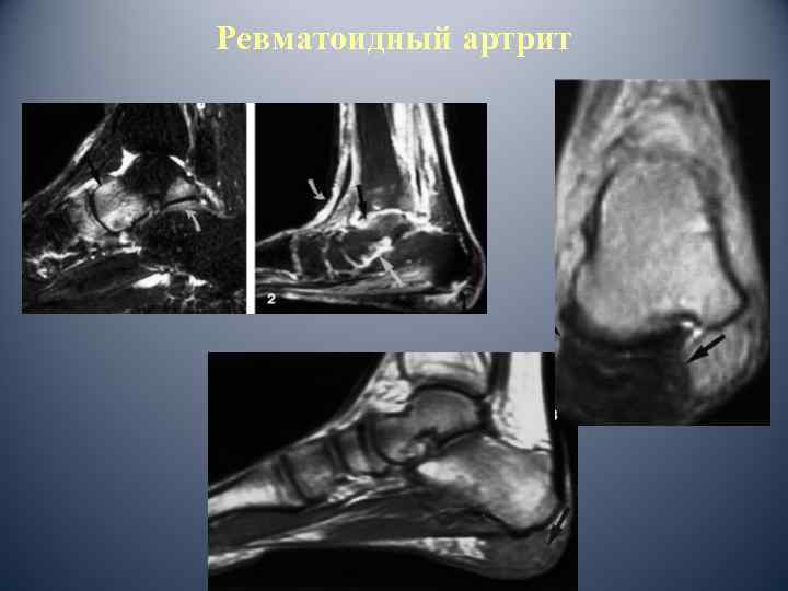 Ревматоидный артрит 