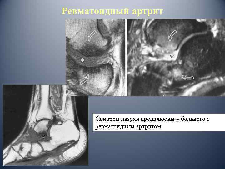 Ревматоидный артрит Синдром пазухи предплюсны у больного с ревматоидным артритом 