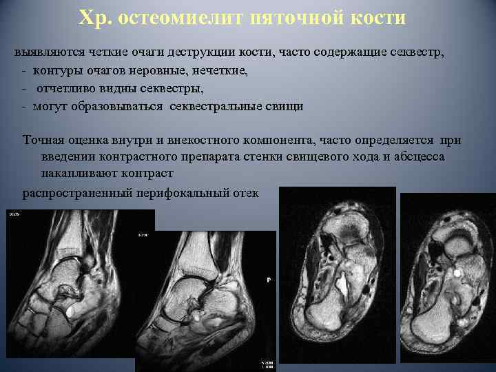 Хр. остеомиелит пяточной кости выявляются четкие очаги деструкции кости, часто содержащие секвестр, - контуры