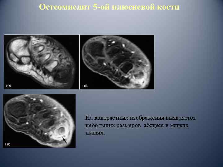 Остеомиелит 5 -ой плюсневой кости На контрастных изображения выявляется небольших размеров абсцесс в мягких