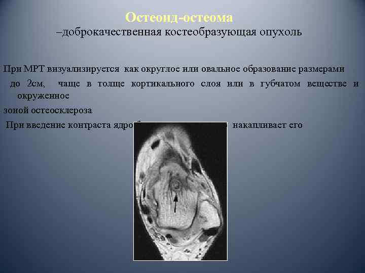 Остеоид-остеома –доброкачественная костеобразующая опухоль При МРТ визуализируется как округлое или овальное образование размерами до