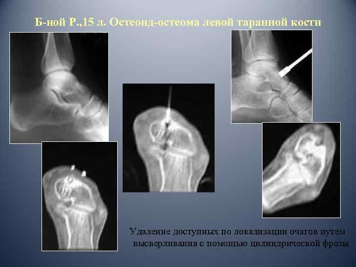 Б-ной Р. , 15 л. Остеоид-остеома левой таранной кости Удаление доступных по локализации очагов