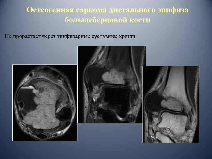 Остеогенная саркома дистального эпифиза большеберцовой кости Не прорастает через эпифизарные суставные хрящи 