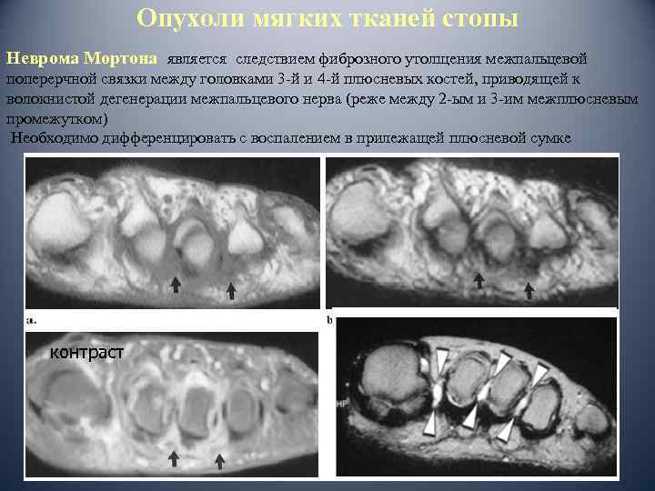 Опухоли мягких тканей стопы Неврома Мортона является следствием фиброзного утолщения межпальцевой поперерчной связки между