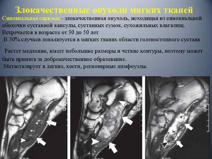 Злокачественные опухоли мягких тканей Синовиальная саркома - злокачественная опухоль, исходящая из синовиальной оболочки суставной