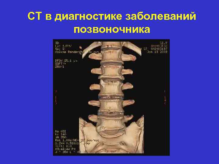 CT в диагностике заболеваний позвоночника 