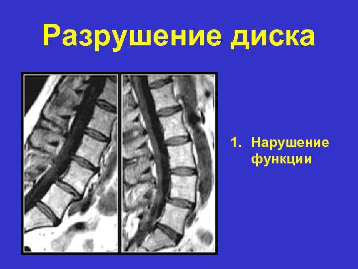Разрушение диска 1. Нарушение функции 