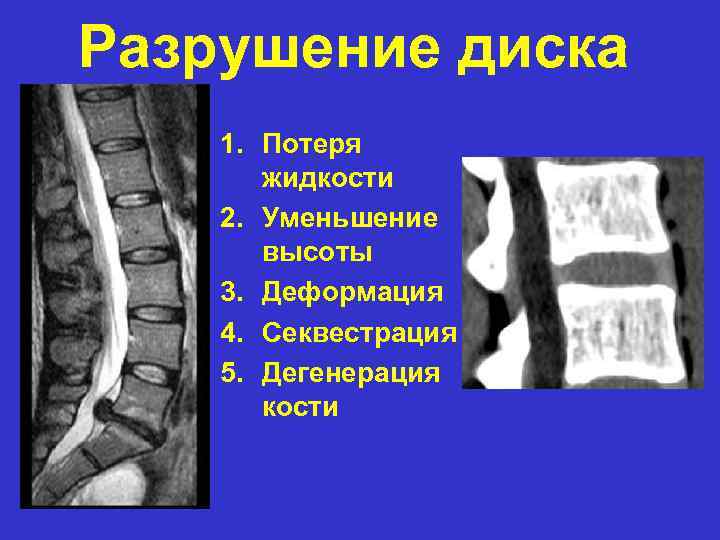 Разрушение диска 1. Потеря жидкости 2. Уменьшение высоты 3. Деформация 4. Секвестрация 5. Дегенерация