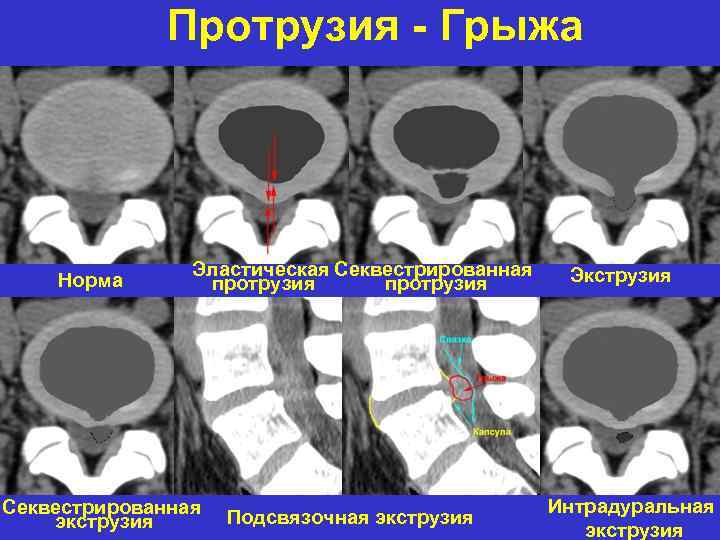 Протрузия - Грыжа Норма Эластическая Секвестрированная протрузия Секвестрированная экструзия Подсвязочная экструзия Экструзия Интрадуральная экструзия