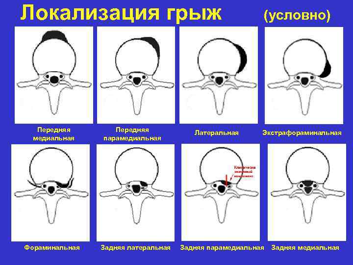 Локализация грыж Передняя медиальная Фораминальная Передняя парамедиальная Задняя латеральная Латеральная (условно) Экстрафораминальная Задняя парамедиальная