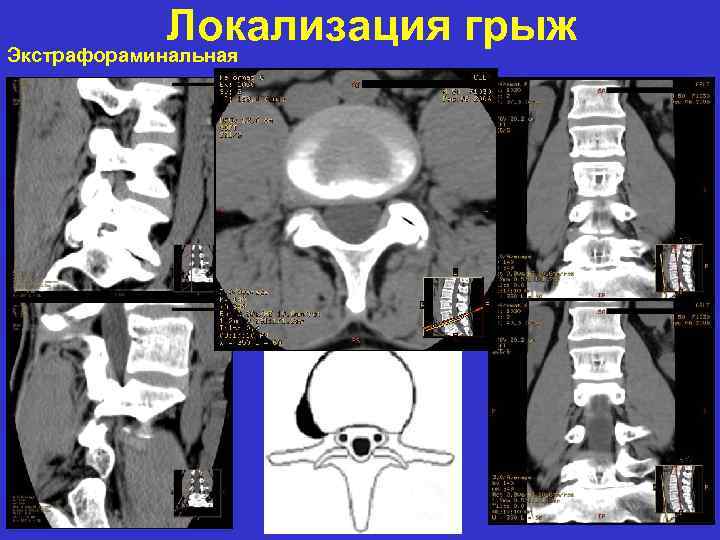 Локализация грыж Экстрафораминальная 