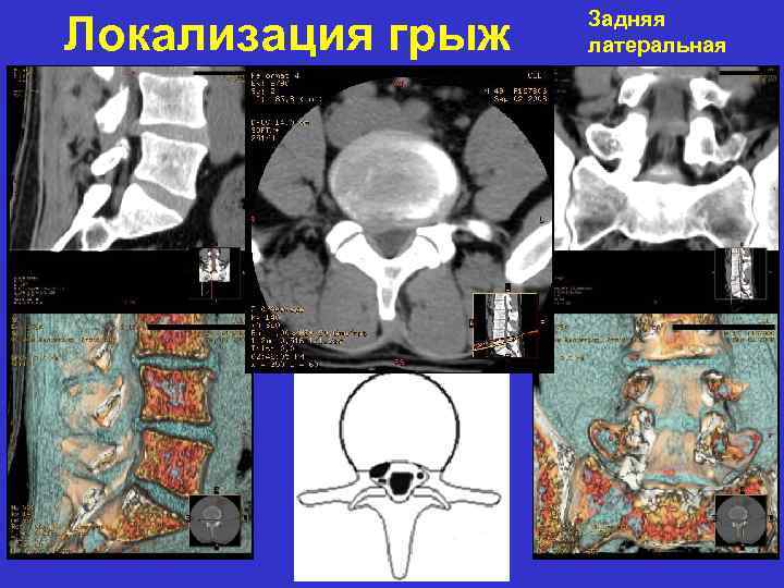 Локализация грыж Задняя латеральная 