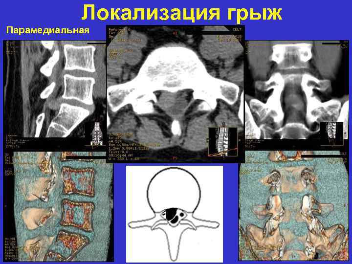 Локализация грыж Парамедиальная 