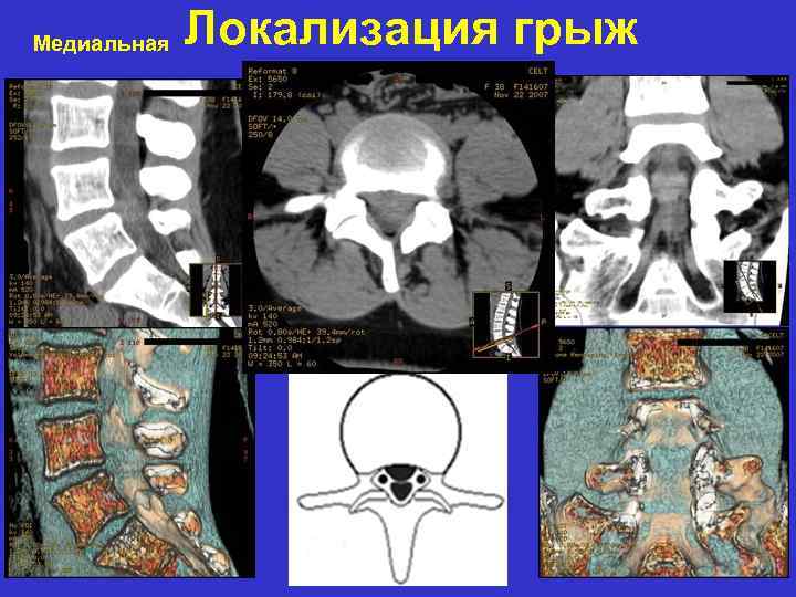 Медиальная Локализация грыж 