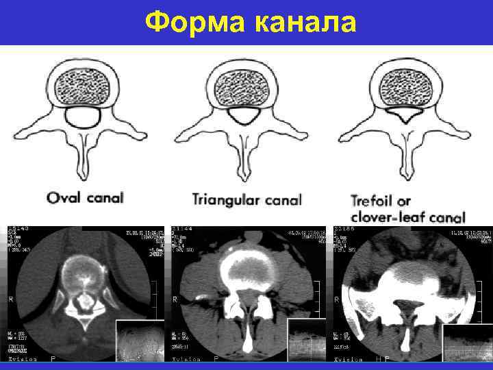 Форма канала 
