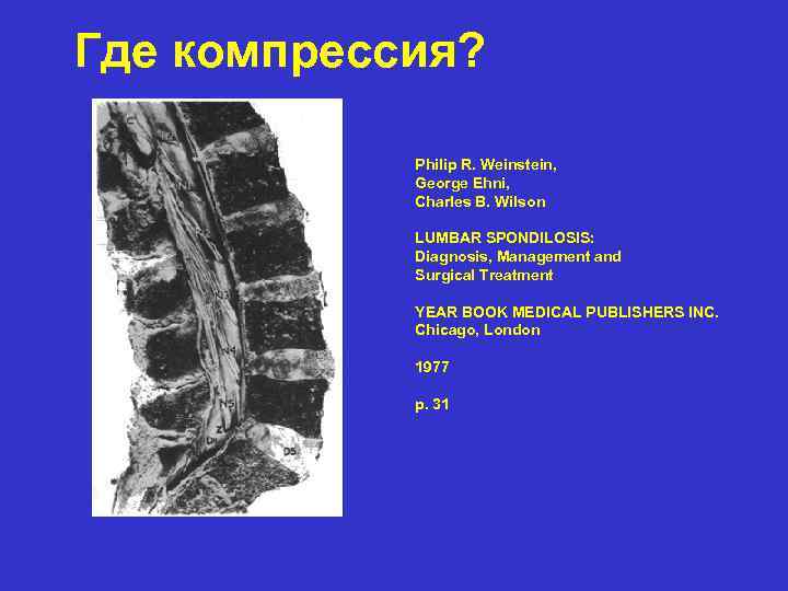 Где компрессия? Philip R. Weinstein, George Ehni, Charles B. Wilson LUMBAR SPONDILOSIS: Diagnosis, Management
