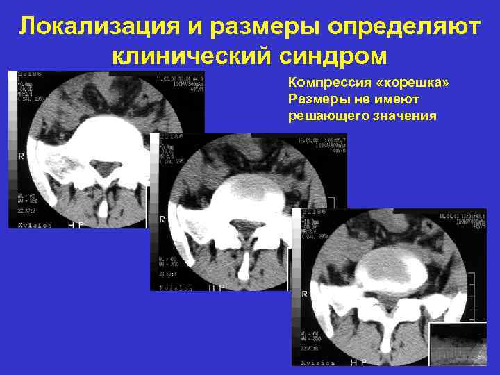 Локализация и размеры определяют клинический синдром Компрессия «корешка» Размеры не имеют решающего значения 