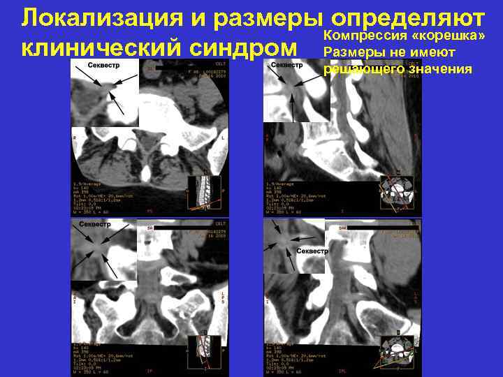 Локализация и размеры определяют Компрессия «корешка» клинический синдром Размеры не имеют решающего значения 