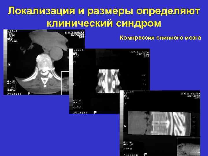 Локализация и размеры определяют клинический синдром Компрессия спинного мозга 