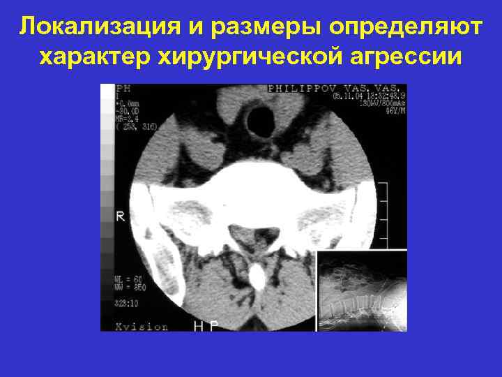 Локализация и размеры определяют характер хирургической агрессии 