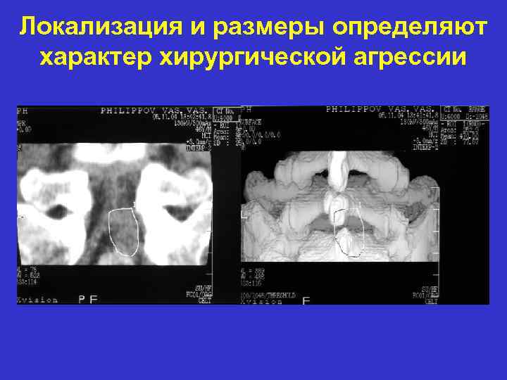 Локализация и размеры определяют характер хирургической агрессии 