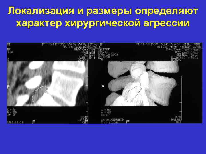 Локализация и размеры определяют характер хирургической агрессии 