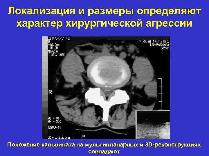 Локализация и размеры определяют характер хирургической агрессии Положение кальцината на мультипланарных и 3 D-реконструкциях