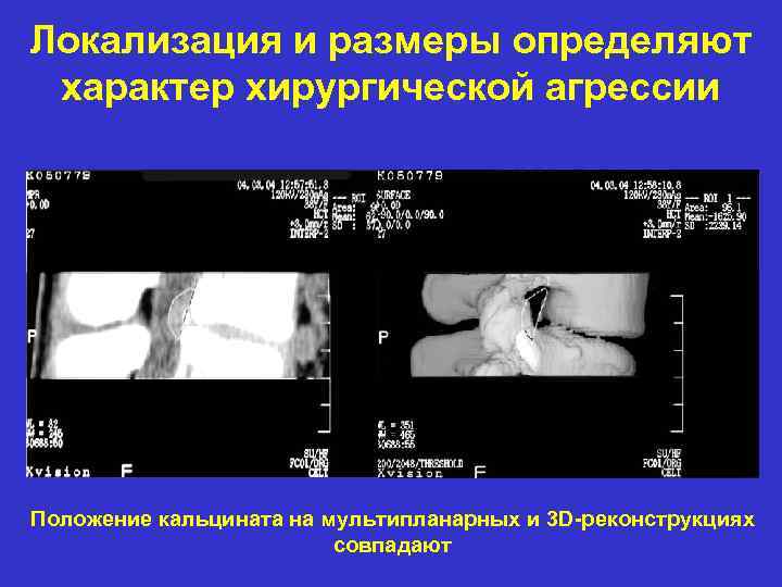 Локализация и размеры определяют характер хирургической агрессии Положение кальцината на мультипланарных и 3 D-реконструкциях