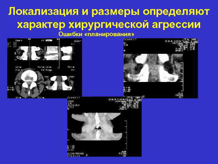 Локализация и размеры определяют характер хирургической агрессии Ошибки «планирования» 