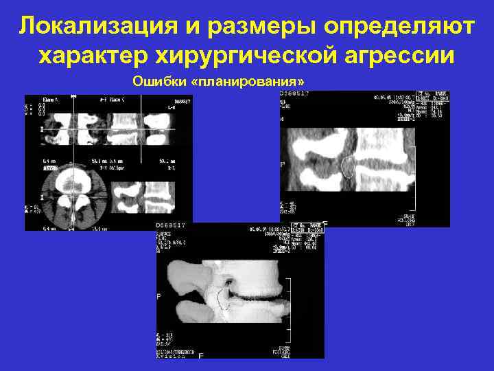 Локализация и размеры определяют характер хирургической агрессии Ошибки «планирования» 