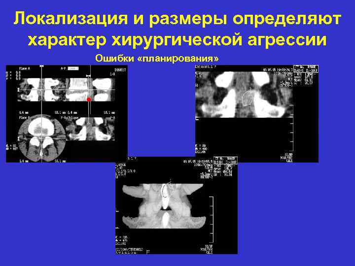 Локализация и размеры определяют характер хирургической агрессии Ошибки «планирования» 