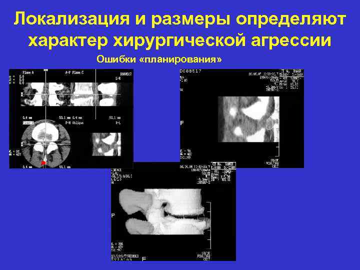 Локализация и размеры определяют характер хирургической агрессии Ошибки «планирования» 