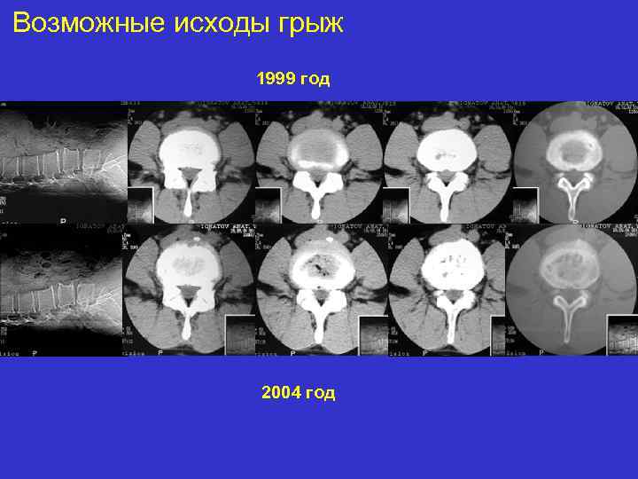 Возможные исходы грыж 1999 год 2004 год 