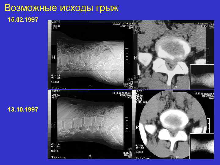 Возможные исходы грыж 15. 02. 1997 13. 10. 1997 