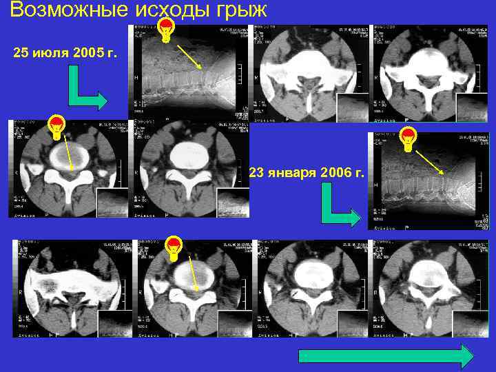 Возможные исходы грыж 25 июля 2005 г. 23 января 2006 г. 