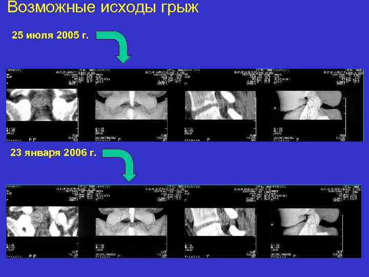 Возможные исходы грыж 25 июля 2005 г. 23 января 2006 г. 