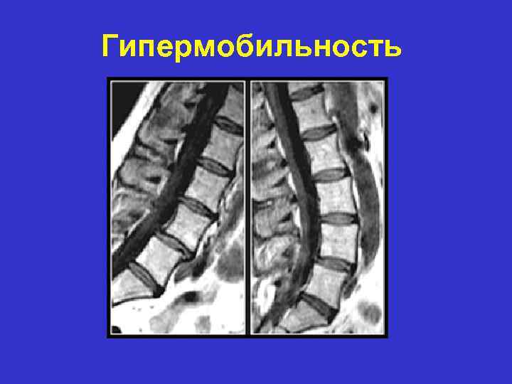 Гипермобильность 