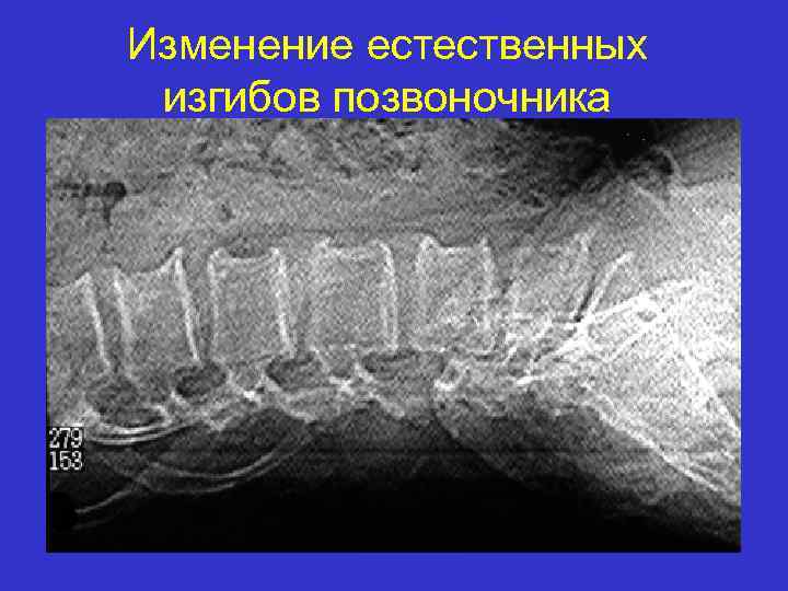Изменение естественных изгибов позвоночника 