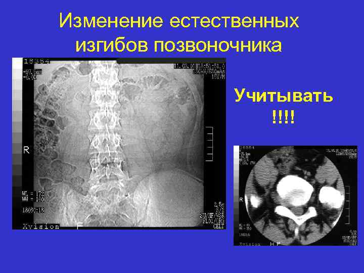 Изменение естественных изгибов позвоночника Учитывать !!!! 