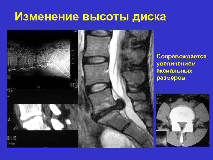 Изменение высоты диска Сопровождается увеличением аксиальных размеров 