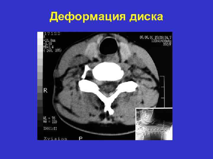 Деформация диска 